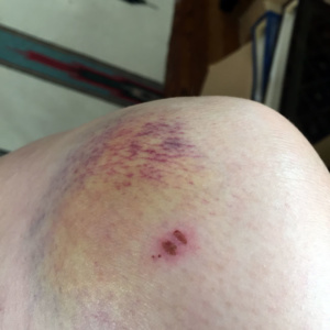 kneebruise